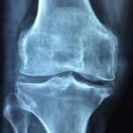 knee, old, care, injury, pain, knee pain, inflammation, osteoarthritis, medical, arthritis, joint pain, health, x, x-ray, skeleton, medicine, anatomy, anatomical, diagnosis, painful, rheumatism, bone, leg, disease, human, cartilage, joint, skeletal, osteoporosis, blue health, blue medical, blue pain, blue medicine, blue human, blue care, blue old, knee, pain, knee pain, knee pain, knee pain, osteoarthritis, arthritis, arthritis, arthritis, arthritis, joint pain, joint pain, joint pain, joint pain, joint, osteoporosis, osteoporosis, osteoporosis, osteoporosis, osteoporosis